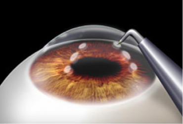 TRATAMIENTO DE LA PRESBICIA CON RADIOFRECUENCIA - CK