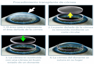 CirugÃas de la cornea - Trasplante